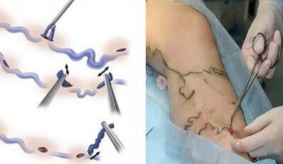 Flebectomy για κιρσοί φλέβες στα πόδια